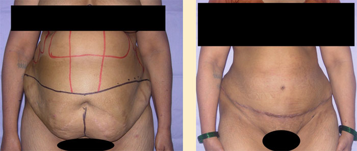 TUMMY TUCK